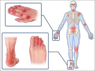 The Basics of Psoriatic Arthritis