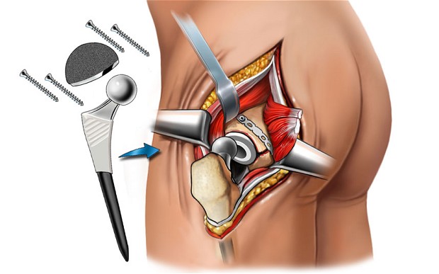 Hip Replacement Revision Surgery